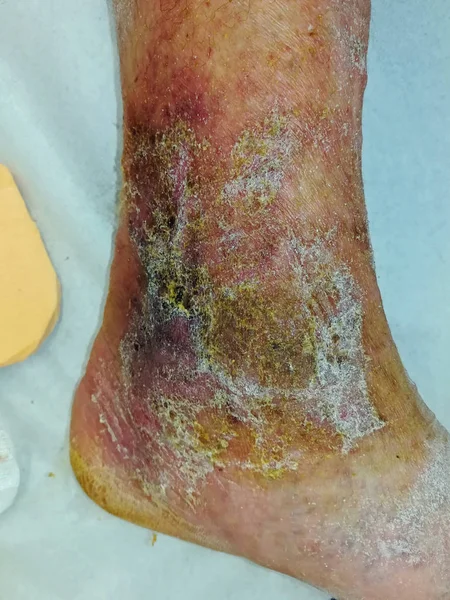 Após Terapia Compressão Úlcera Perna Cicatrizante — Fotografia de Stock