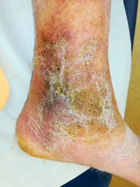 Dopo Terapia Compressione Guarigione Ulcera Alle Gambe — Foto Stock