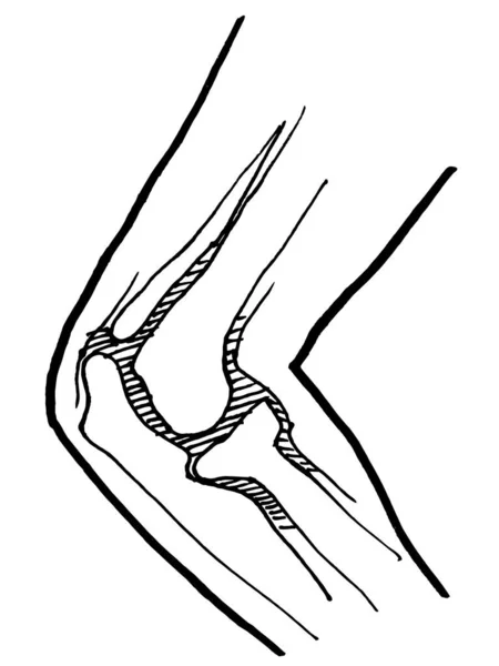 Dibujo Contorno Vectorial Huesos Rodilla Humanos Lesionados Plantilla Editable Diseño — Vector de stock