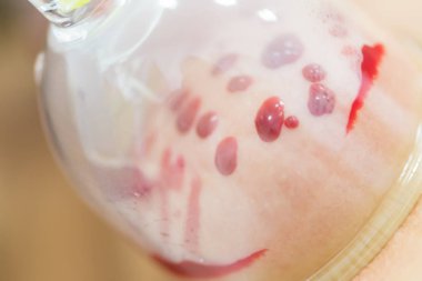 Hijama - kan alma tedavisi. Vakum çan bağlı. Kan dolgular Kupası.