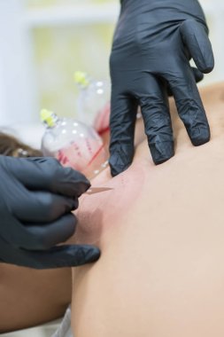 Hijama - kan dökülmesi tedavisi. Ekli vakum bardak. Skarlaştırma süreci.