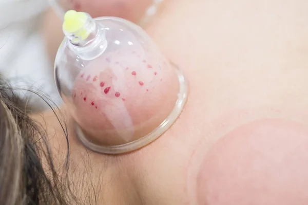 Hijama - o tratamento da sangria. Copo de vácuo anexado. Processo de escarificação . — Fotografia de Stock