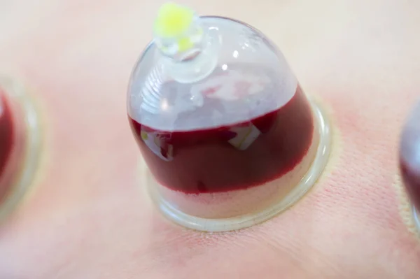 Hijama - behandling av åderlåtning. Bifogade vakuum cup. Blod fyller i cupen. — Stockfoto