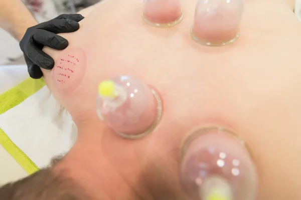 Hijama-leczenie puszczania krwi. Dołączony kubek próżniowy. Proces scarification. — Zdjęcie stockowe