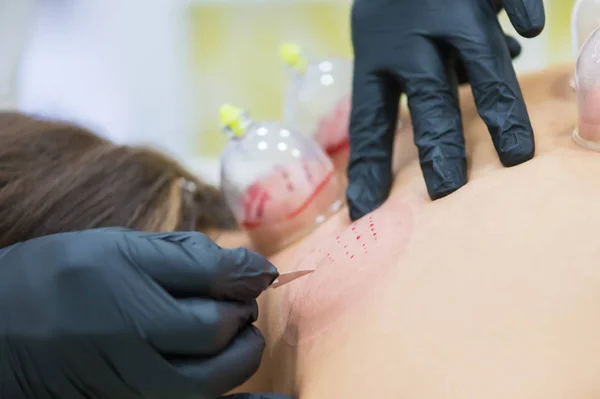 Hijama - il trattamento del salasso. Tazza sottovuoto attaccata. Processo di Scarificazione . — Foto Stock