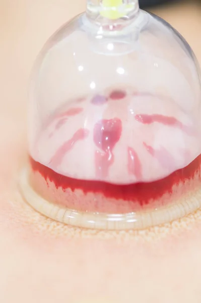 Hijama--放血的治疗。连接真空杯。血液充满在杯子里. — 图库照片