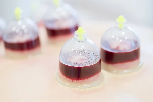 Hijama - the treatment of bloodletting. Attached vacuum cup. Blood fills in the cup. — Stock Photo, Image