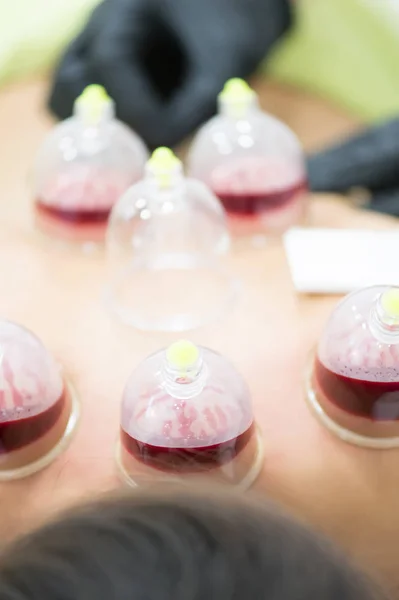 Hijama - behandling av åderlåtning. Bifogade vakuum cup. Blod fyller i cupen. — Stockfoto