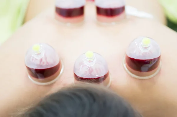 Hijama - o tratamento da sangria. Copo de vácuo anexado. Sangue preenche o copo . — Fotografia de Stock