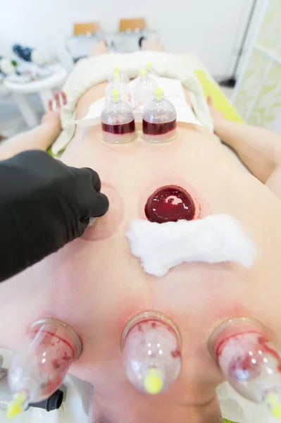 Primo piano di giovane uomo sdraiato al tavolo da massaggio e fare il trattamento hijama. processo di pulizia del sangue . — Foto Stock