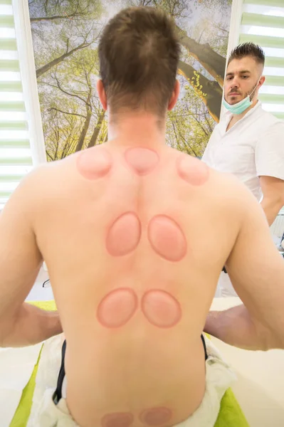 Young man sitting at the massage table and showing the hijama treatment scar. — Stock Photo, Image