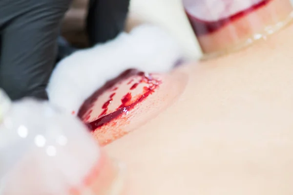 Primo piano del giovane che fa il trattamento hijama. processo di pulizia del sangue — Foto Stock