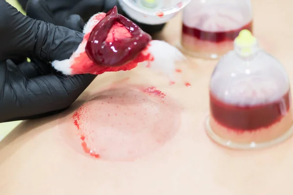 Närbild av ung person som gör hijama behandling. Blod reningsprocessen — Stockfoto