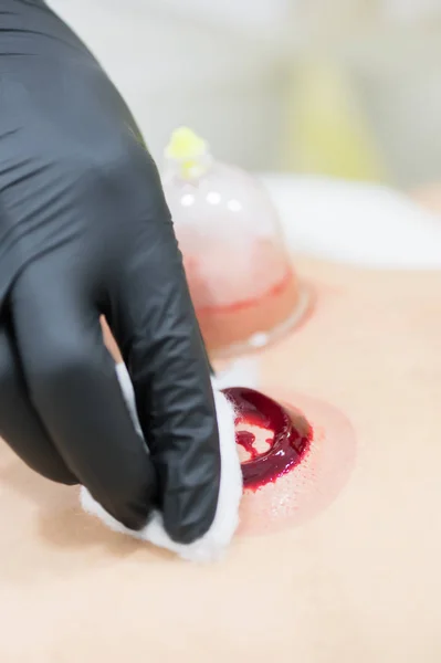 Närbild av ung person som gör hijama behandling. Blod reningsprocessen — Stockfoto