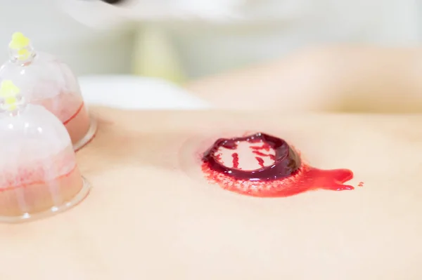 Close-up de jovem fazendo tratamento hijama. Processo de limpeza do sangue — Fotografia de Stock