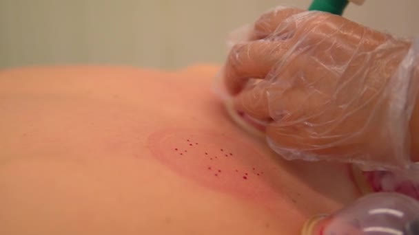 Cupping terapia medicina alternativa — Vídeo de Stock