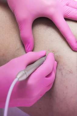 Tıbbi klinikte lazer kılcal kaldırma prosedürü closeup