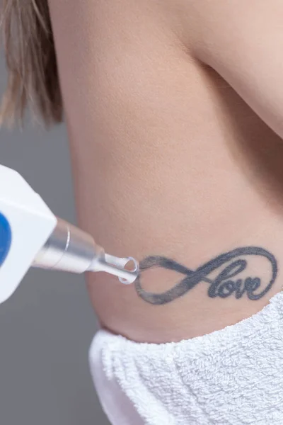 Enlèvement de tatouage laser en clinique gros plan — Photo