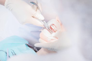 Açık kadın insan ağzı paslanmaz çelik ayraçlar gösterilen aşırı makro closeup. Yükleme ve kaldırma kaşlı ayraç diş hekimine muayene