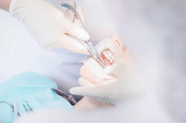 Extreme macro closeup of open female human mouth showing stainless steel braces. Inspection of the installation and removal of braces by the dentist