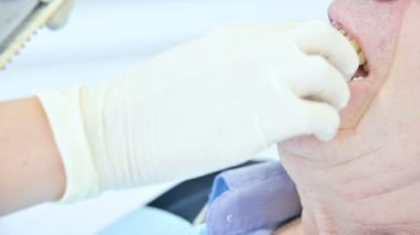 Yakın çekim stomatologist bir protez oluşturmak hasta için bir renk seçer. 4k diş hekimliği. Ağzından polimer kalıp kaldırma kaldırma