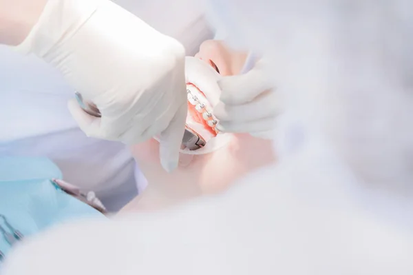 Extreme macro closeup of open female human mouth showing stainless steel braces. Inspection of the installation and removal of braces by the dentist — Stock Photo, Image