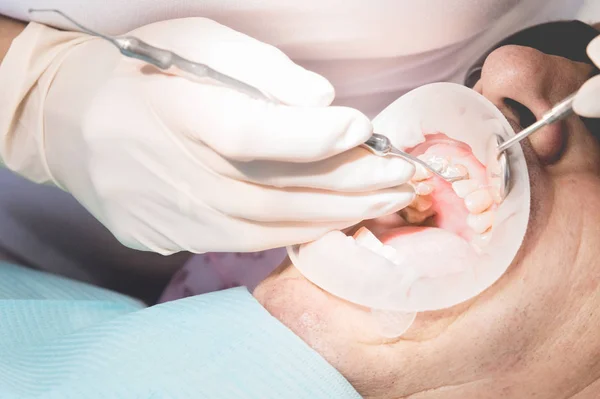 Μακροεντολή ακραία closeup ανοιχτό ανδρική το ανθρώπινο στόμα δείχνει την προετοιμασία για την εγκατάσταση των οδοντοστοιχιών. Ψεύτικα δόντια εγκατάσταση άνδρες ηλικίας — Φωτογραφία Αρχείου
