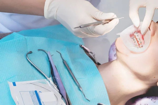 Μακροεντολή ακραία closeup ανοιχτό το θηλυκό ανθρώπινο στόμα δείχνει ανοξείδωτο ατσάλι άγκιστρα. Επιθεώρηση της εγκατάστασης και αφαίρεση των ιμάντων από τον οδοντίατρο — Φωτογραφία Αρχείου