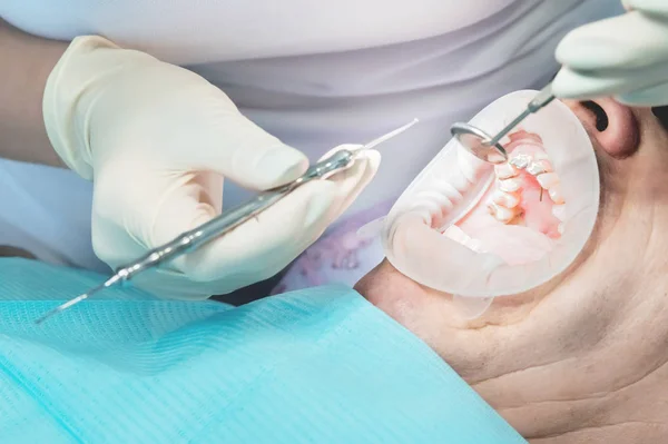 Μακροεντολή ακραία closeup ανοιχτό ανδρική το ανθρώπινο στόμα δείχνει την προετοιμασία για την εγκατάσταση των οδοντοστοιχιών. Ψεύτικα δόντια εγκατάσταση άνδρες ηλικίας — Φωτογραφία Αρχείου