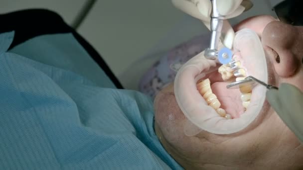 Γυναίκα οδοντίατρος με βοηθός εξετάζει το στόμα ένας άνθρωπος ενός άνδρα ηλικίας ασθενείς. Υψηλή βασική επαγγελματική εργασία οδοντιάτρου σε οδοντιατρείο — Αρχείο Βίντεο