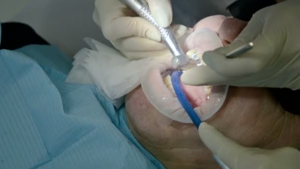 La dentista con un assistente esamina la bocca dei pazienti di un uomo di un uomo anziano. Alto lavoro professionale chiave di un dentista nella clinica dentale — Video Stock