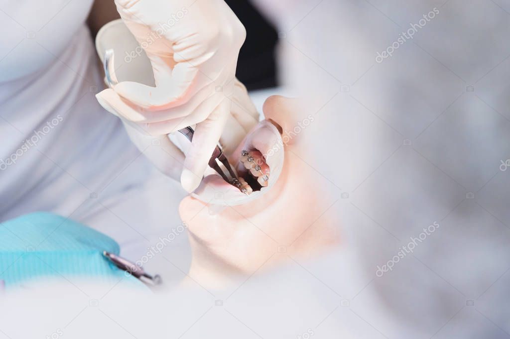 Extreme macro closeup of open female human mouth showing stainless steel braces. Inspection of the installation and removal of braces by the dentist