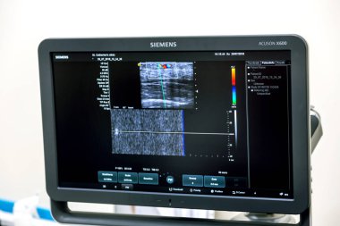 Odessa, Ukrayna - 29 Temmuz 2018: Kadın muayene damarların ultrason sensör modern teknoloji Kliniği üzerinde uğrar. Damarlar ve doppler incelenmesi monitör durumu