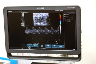 Odessa, Ukrayna - 29 Temmuz 2018: Kadın muayene damarların ultrason sensör modern teknoloji Kliniği üzerinde uğrar. Damarlar ve doppler incelenmesi monitör durumu