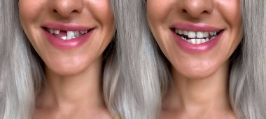 Kırık ön diş ve rekonstrüksiyon - implant