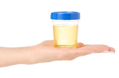 Plastik Konteyner ile idrar el Analizi