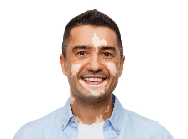 Glücklich lächelnder Mann mit Vitiligo — Stockfoto