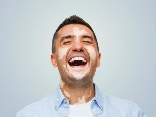 happy laughing man with vitiligo