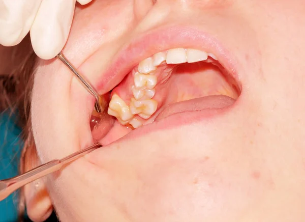 Dentizione Anomala Della Mascella Superiore Distopia Del Secondo Molare Superiore — Foto Stock