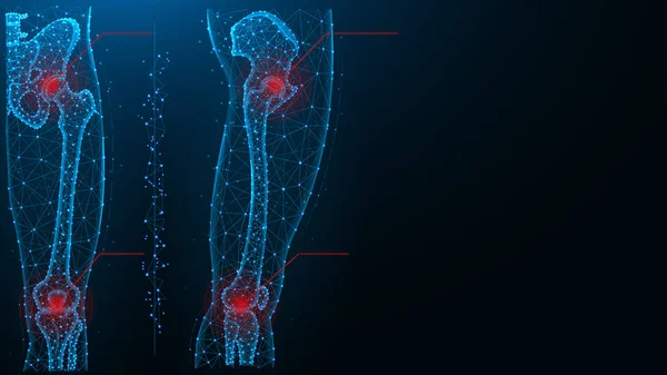 髋关节和膝关节疼痛蓝色多边形矢量图 — 图库矢量图片