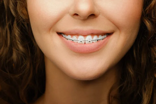 Detailní Záběr Krásné Ženské Úsměv Bílými Zuby Nosit Zubní Rovnátka — Stock fotografie