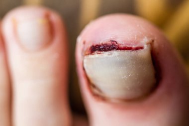 Travmatik kazara uzak parmak kaldırmaya yeni kırık tırnak