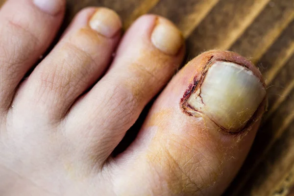Πρόσφατα Σπασμένα Νύχια Έτοιμος Άρει Μακριά Από Δάχτυλο Από Τραυματικό Εικόνα Αρχείου