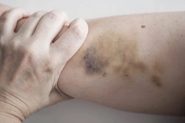 Large hematoma on human arm — Stock Photo, Image