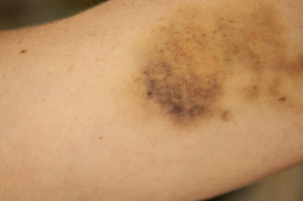 большая гематома на руке человека
