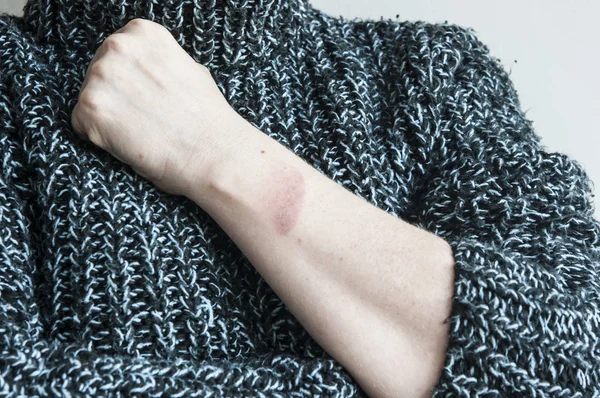 Injury from a burn on a female hand close up view — Stock Photo, Image