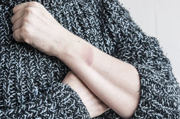 Injury from a burn on a female hand close up view — Stock Photo, Image