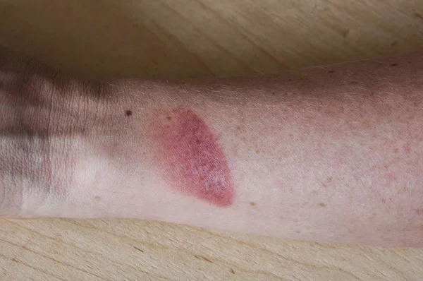 Blessure par brûlure sur une main féminine vue de près — Photo