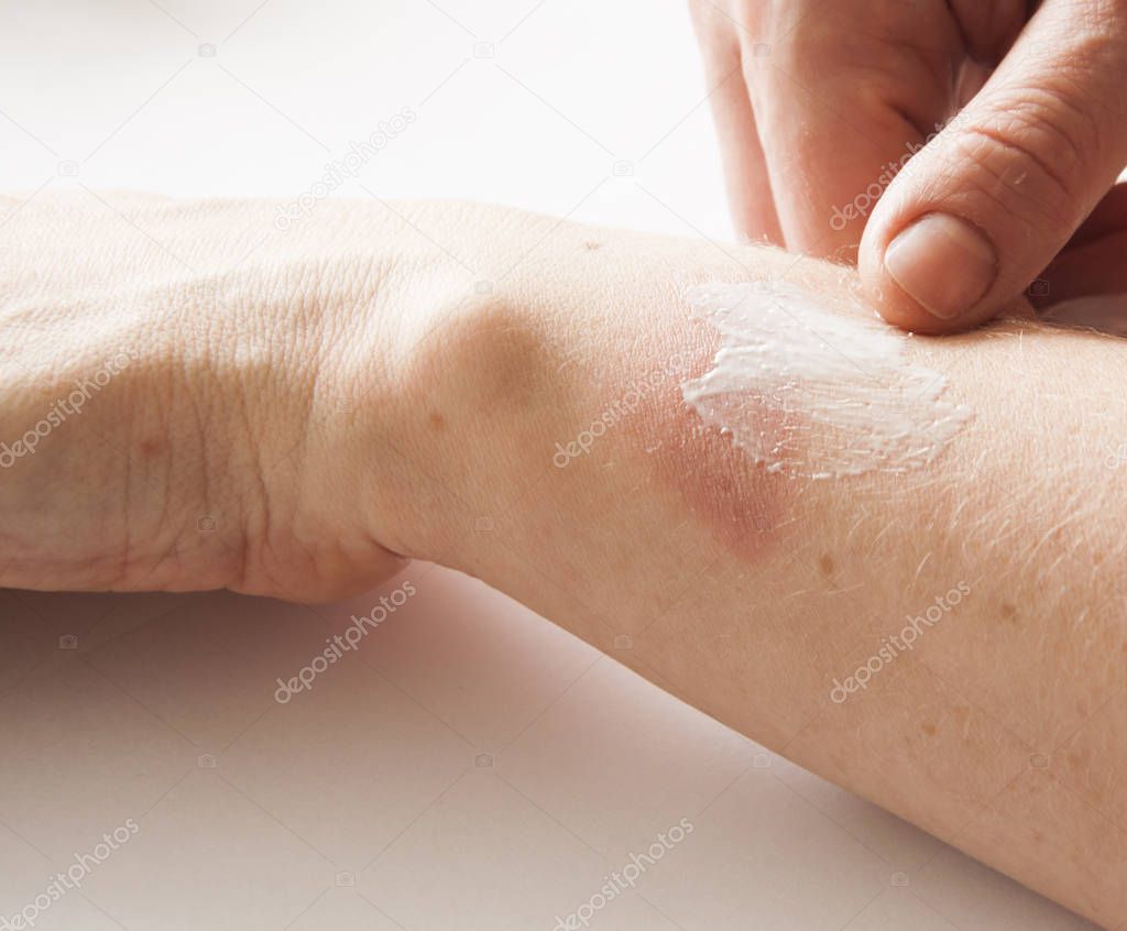 Treatment of burns on female hand on white