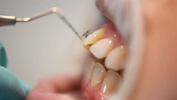 Inspeção Instalação Aparelhos Pelo Dentista Extremo Close — Vídeo de Stock